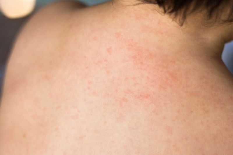 Sốt Phát Ban Có Nằm Máy Lạnh Được Không? Các Lưu Ý Cần Biết 2025 sốt phát ban nằm máy lạnh được không