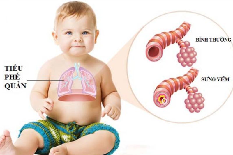 trẻ bị viêm phế quản
