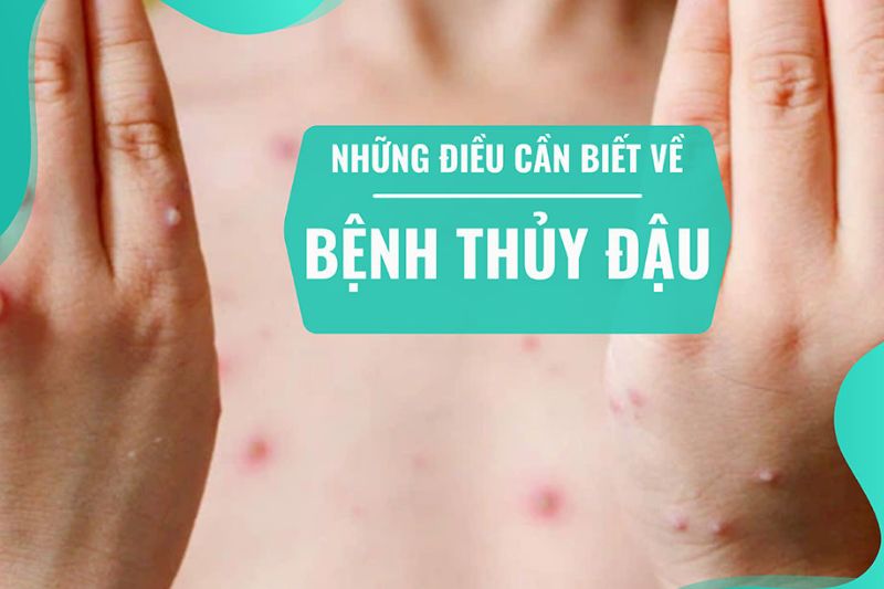 bị thủy đậu nằm máy lạnh