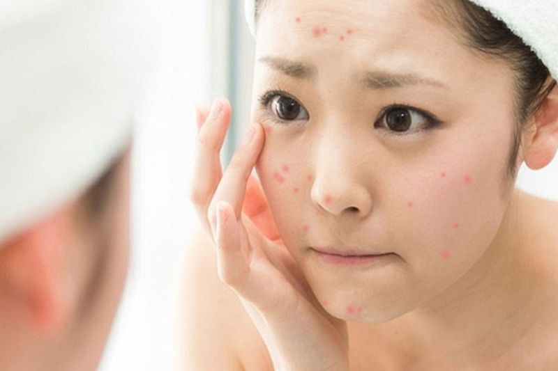 nổi mụn